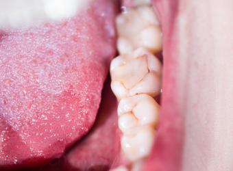 4 Signs that Your Dental Filling Is Going Bad