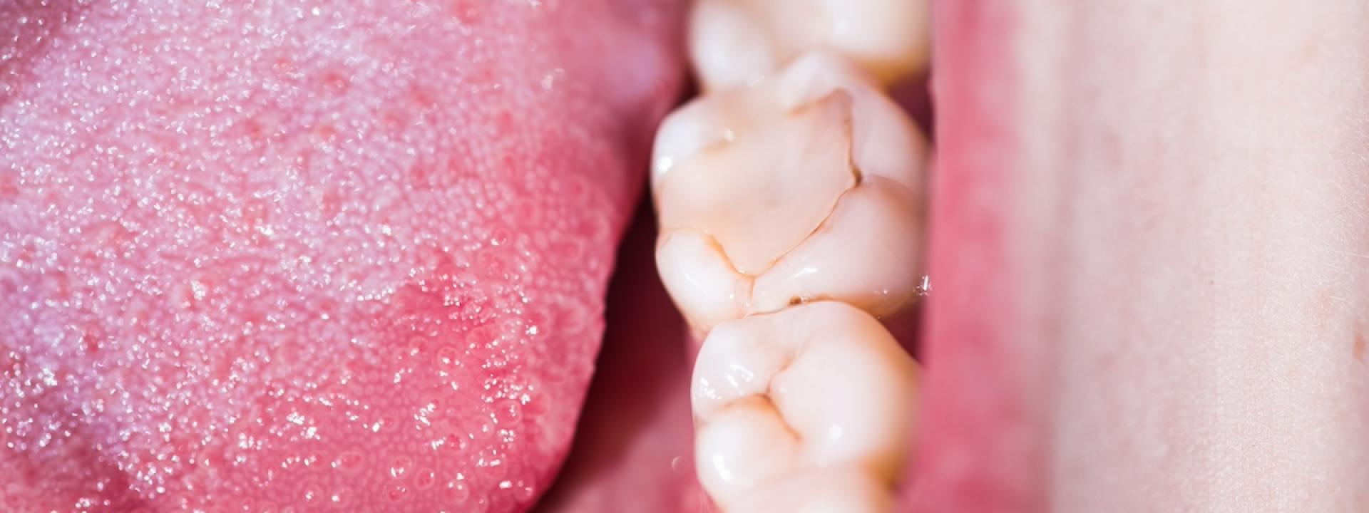 Signs that Your Dental Filling Is Going Bad