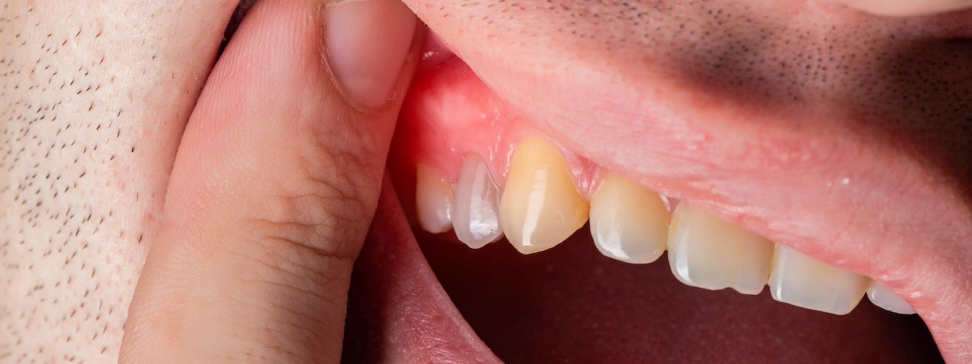 Dental Gum Health